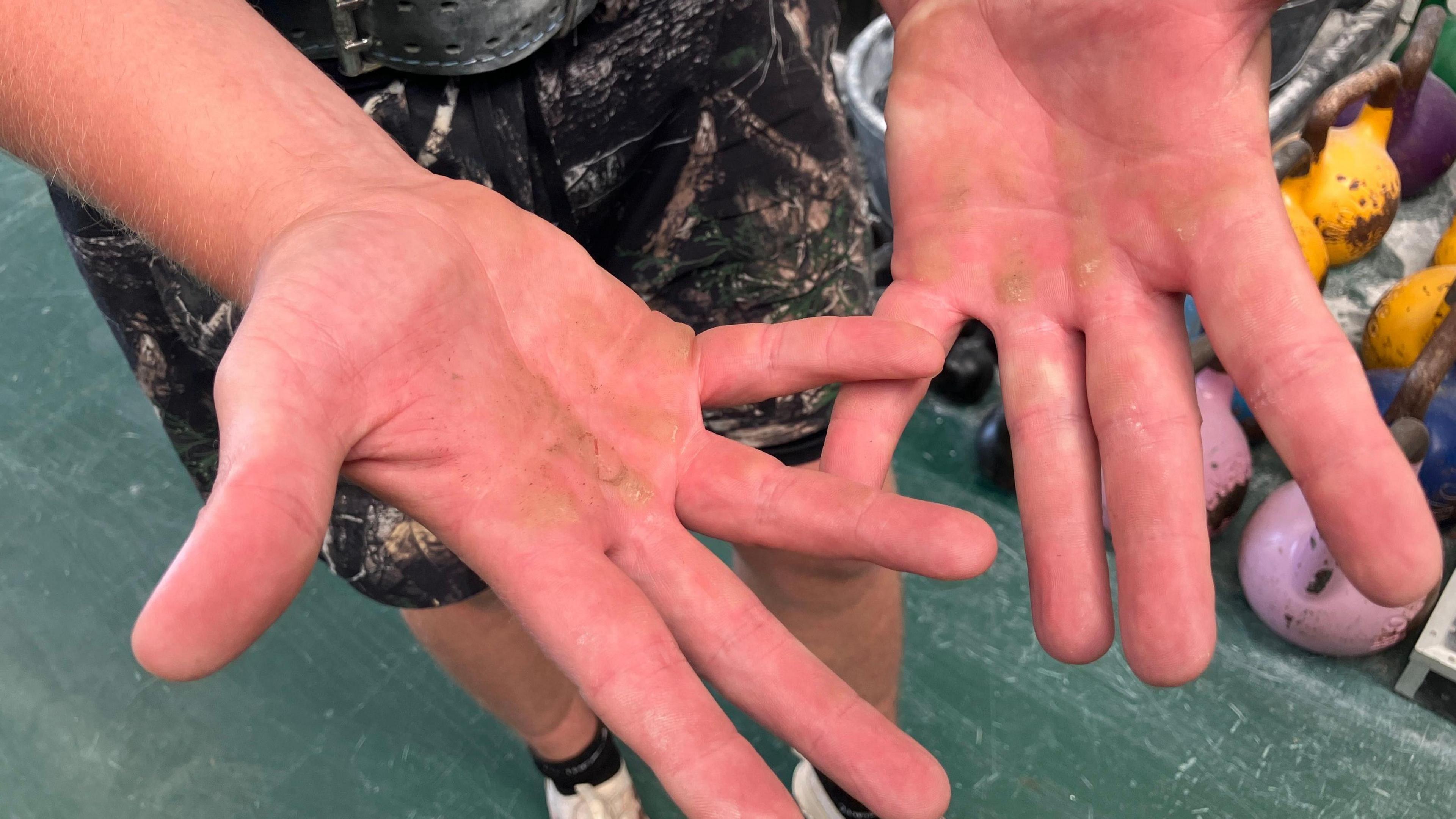 A close-up of a person's hands, with patches of hardened skin at the top of the palms from gripping kettlebells