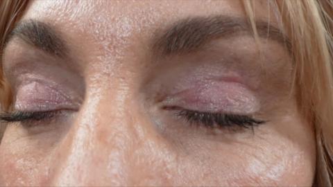 Close-up of woman's eyes showing scars
