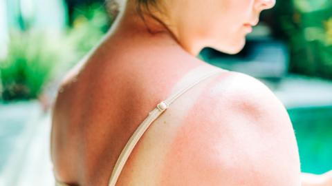 A close up photo showing a young woman with sunburn on her back and shoulders